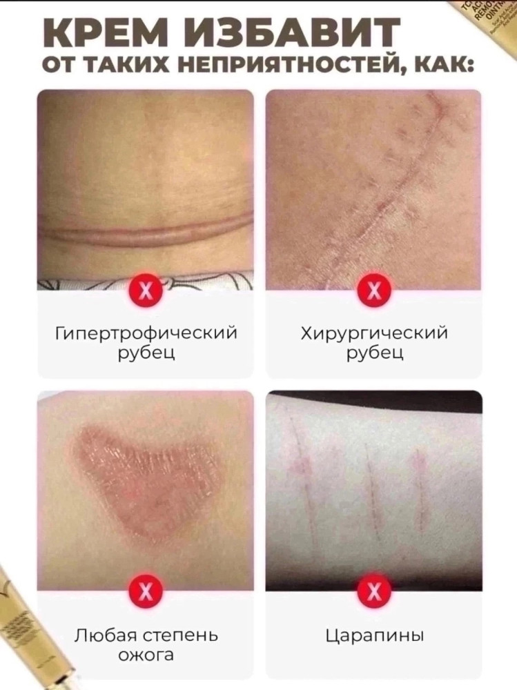 Крем от рубцов и следов от акне купить в Интернет-магазине Садовод База - цена 250 руб Садовод интернет-каталог